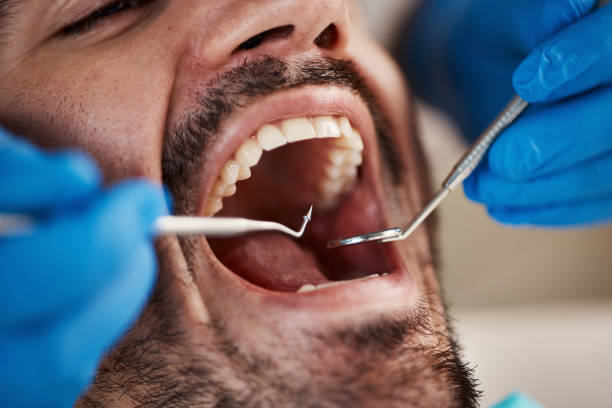 Best Chipped Tooth Repair Near Me  in Vero Lake Estates, FL