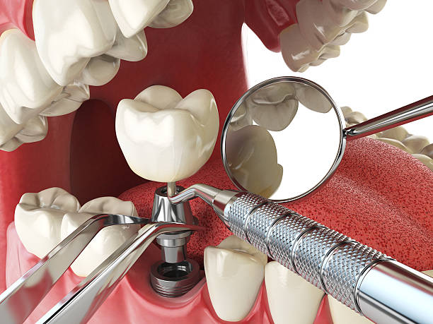 Best Root Canal Emergency Dentist  in Vero Lake Estates, FL